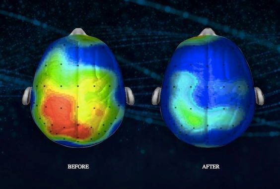 Hjernen før og efter meditation