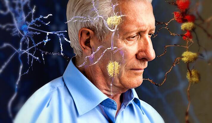 Alzheimers illustreres gennem neuroner