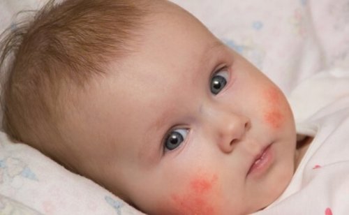 baby med atopisk dermatitis