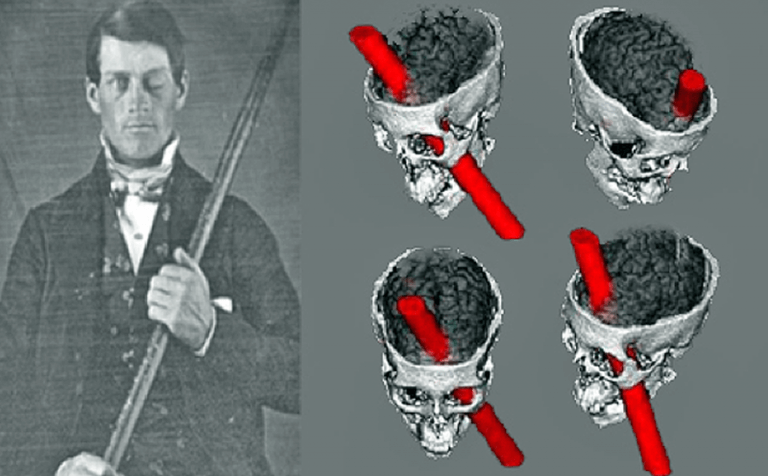 Phineas Gage er eksempel på et spændende kliniske tilfælde