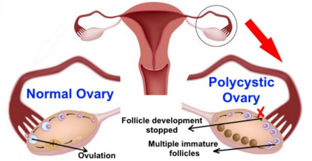 Grafik der viser PCOS