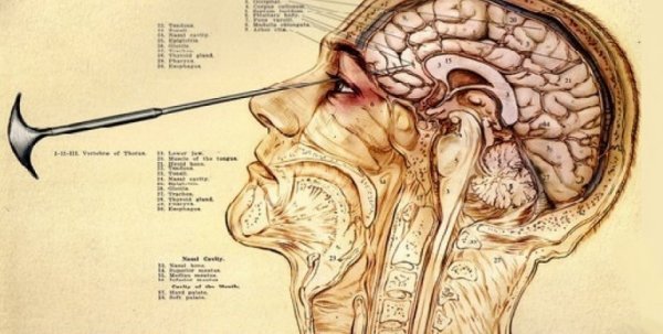Walter Freeman fandt ud af, at man lettere fik adgang til hjernen gannem øjnene
