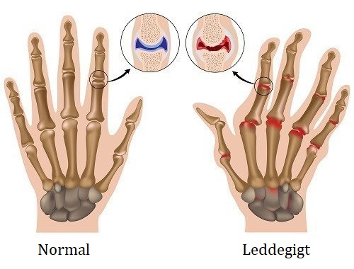 Leddegigt illustreret i hænder