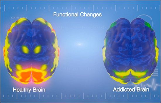 En misbrugers hjerne kontra en sund hjerne