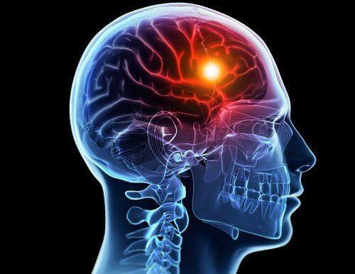 Lys i hjerne illustrerer årsager til et interkranielt aneurisme