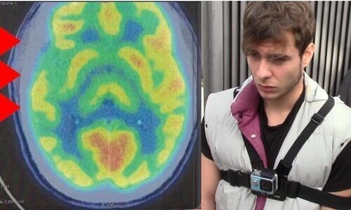 en hjernescanning viser abnormitet i hjernen