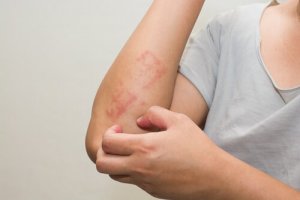 6 tips til behandling af atopisk eksem