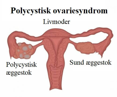 Lær alt om polycystisk ovariesyndrom