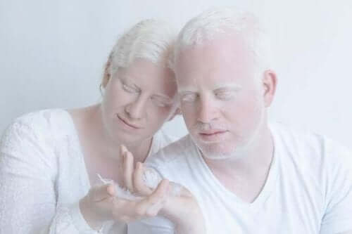 Par, der lever med albinisme