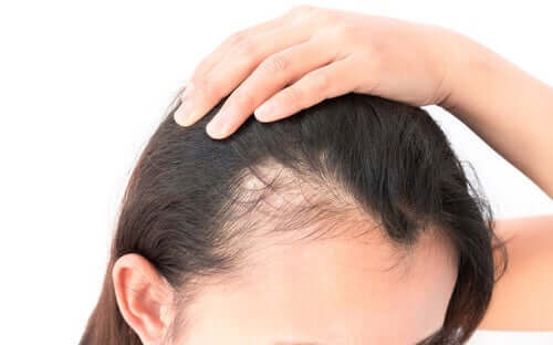Alopecia hos kvinder