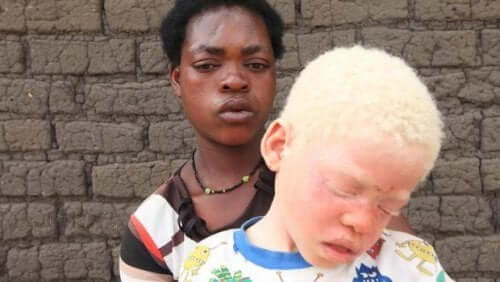 Sort mor med albino barn