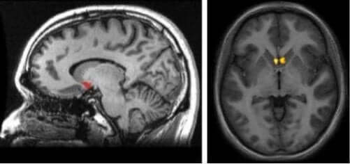 Scanning af nucleus accumbens