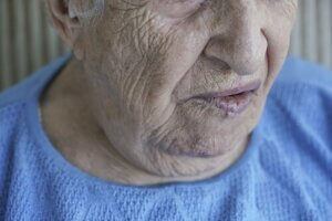 Ansigtslammelse: Årsager og behandlinger