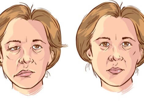 Ansigtslammelse kan have voldsom effekt på en persons udtryk