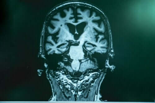 Scanning af hjerne