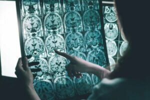 Stimulation af hjernebølger til personer med Alzheimers