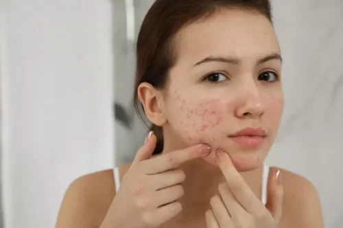 Teenagepige med uren hud oplever de psykologiske konsekvenser af akne